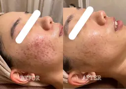 💚18~22歳限定価格”💚最高峰ハーブトリートメント 【ニキビ・ニキビ跡・毛穴】