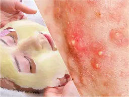 【肌質改善コース】ニキビケア