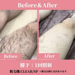 【男性限定/スタッフ施術】お顔/VIO/全身脱毛☆極上美肌脱毛コース☆