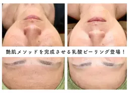 【ホームケア用品付き】艶肌・美白◆乳酸ホワイトニングピール