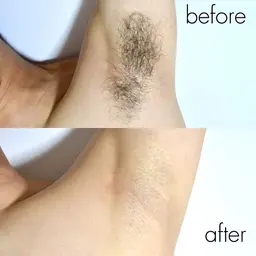 【MEN'S】ワキ ワックス×美容脱毛