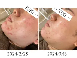 【68％オフ‼️】【ハーブピーリング｜ニキビ徹底ケア◎】カウンセリング込み120min(31,900円→10,000円)