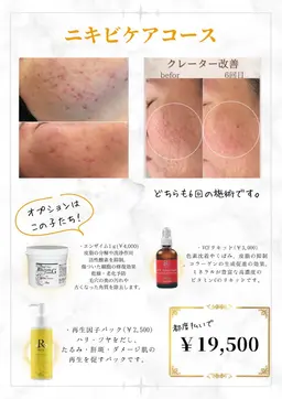 ハーブピーリング🌿ニキビにお悩みの方✨