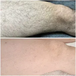 足全部脱毛(左右表裏)