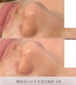 【全顔ピーリングパック+ハイドラ毛穴洗浄＋水光パック】一回で効果実感の声多数💡