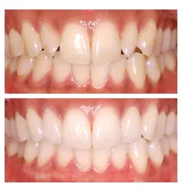 《セルフホワイトニング🦷✨》