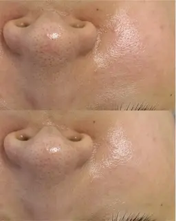 【毛穴集中ケア】毛穴引き締め高周波(選べる1パーツ)✨