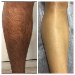 12月は全員対象✴︎ひざ下脱毛2000円