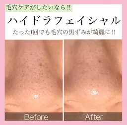 【毛穴洗浄🫧】人気NO.1 ハイドラフェイシャル✨