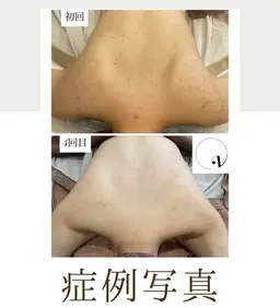 背中ハーブピーリング（背中上部のみ）🌿気になる背中ニキビ・背中の色素沈着💦ウェディング👰‍♀️等に人気⭕️