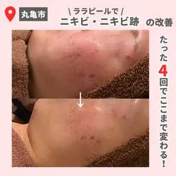 【モニター価格】ララピール＋カウンセリング