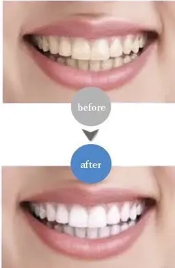 【研修生クーポン】12月限定★ 口コミ書いていただける方限定セルフホワイトニング10分×2回　550円