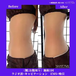 定額マシン1種類★脱毛/痩身美顔/ホワイトニング/フェイシャル/毛穴洗浄のどれか1つ