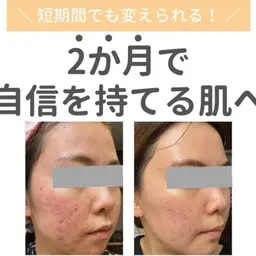 敏感肌（乾燥・赤み）【角質ケア+鎮静・高保湿美容液導入+肌質別パック】で鎮静×修復×エイジングが一緒に叶う♥