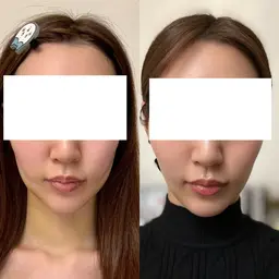 ミニモ限定🌸【ひきつれ/拘縮緩和🌼】脂肪吸引後 術後ケア 30分