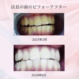 ※緊急値下げ【医療ホワイトニングで速攻で白くしたい方】お急ぎパック