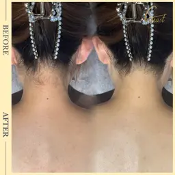 【まとめて解決💫】うなじから繋がる背中のムダ毛まで集中脱毛。背中うなじ脱毛