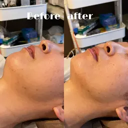 【二重顎撃退👊✨】切らないリフトアップ3000ショット