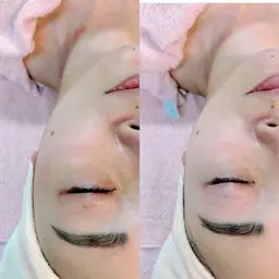 フェイシャルエステ