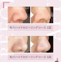 毛穴ピーリングコース【顔全体】