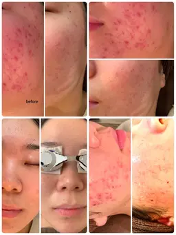 【エアポテンツァ】〔男女可能〕ミニモ限定！肌荒れ・ひどいニキビ・クレーター・シワ・タルミ・ハリ・小顔
