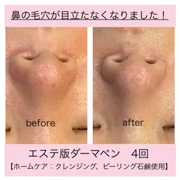 【韓国発浸透美容！毛穴・シミ・ニキビ跡を解消し陶器肌に】ピーリング＋IPL光フェイシャル＋ダーマペン＋鎮静ジェルパック