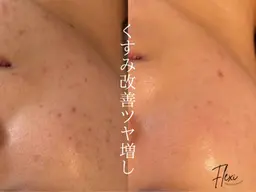 【小顔&美肌の同時ケア】小顔矯正＋毛穴レスピーリングコース
