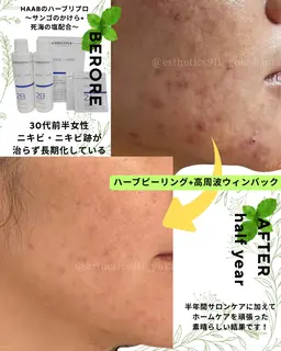 【お昼限定】肌荒れ！サンゴハーブピーリング🌿&高周波フェイシャルエステコース初回体験