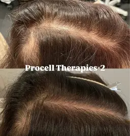 プロセルセラピーズ×頭皮環境改善コース/育毛