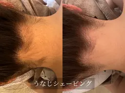 【シェービング】背中全体＋うなじ＋肩＋二の腕