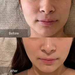 初回!整形級に小顔なれる レモン🍋ボトル2cc