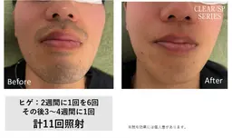 【国内産】NBS美容全身脱毛《お髭》（体験から本格へ）