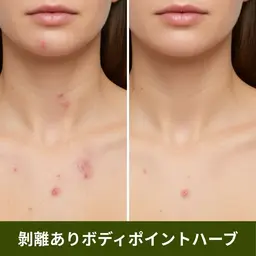 【ポイント施術】ボディハーブピーリング(剥離あり)ヒト幹細胞培養上清液入りハーブ🌿お尻/背中上or下/デコルテ/足/腕