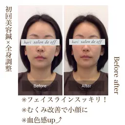 ♡当日限定♡なんと半額以下❣️【極上リッチ小顔ケア】美容鍼／リフトアップ美容鍼➕小顔矯正➕ドライヘッドスパ（60分）