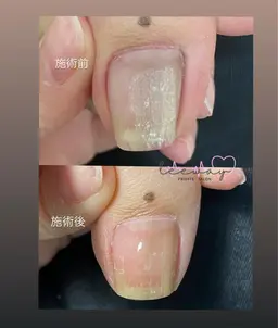 巻き爪ケア（無料カウンセリング）