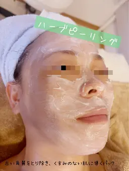 ノーダメージハーブピーリング