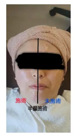 一番人気!顔痩せ小顔リフトアップ ラジオ波フェイシャルフルコース (60分)