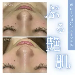 顔脱毛➕ポレーションフェイシャル
