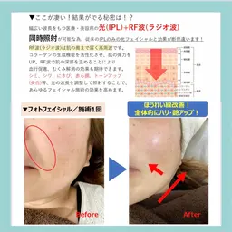 シミ，シワ，たるみ等、あらゆるお悩みに効果的な💆🏻‍♀️お試し初回光エステ💓