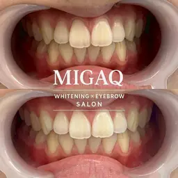 【OPEN記念】🦷美歯口ホワイトニング30分🦷