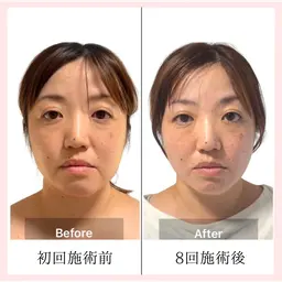 【小顔・たるみケア集中プログラム】60分×８回