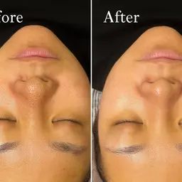 ⭐️高級WAXでお顔脱毛パック付き⭐️平日限定⭐️角質も取れてお肌ツヤツヤお肌に…