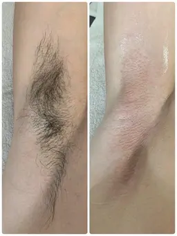 ムダ毛スッキリ！蒸れ知らず♪脇ワックス