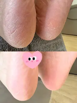 フットケア