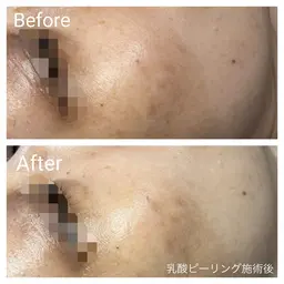 🌼夏にお勧め🌼【日焼けによるシミ、ニキビ跡、美白に】お肌に優しい低刺激乳酸ピーリングフェイシャル60分