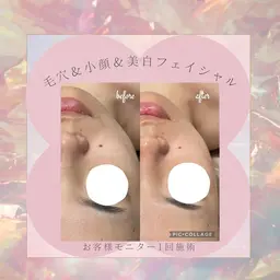 8月限定🌻夏の肌疲れに🌻【毛穴×小顔フェイシャル】紫外線と暑さで毛穴の広がりが気になる方へ✨2980円