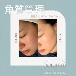 【韓国式角質管理】剥離なし！痛みなし！◇水光肌ラダメールピーリング＆水光肌セラム40分コース￥4,950