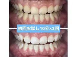 【平均2​〜​4トーンアップ✨】自然な歯の白さを目指すホワイトニング✨〈10分×3回〉