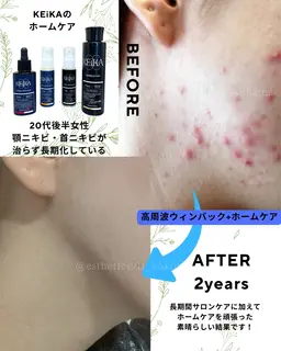 【お昼限定】肌荒れニキビ毛穴ケア！水素高周波のWアプローチ！フェイシャルエステコース初回