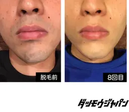 顔･ヒゲ脱毛(鼻下,口下,両頬,あご,首)